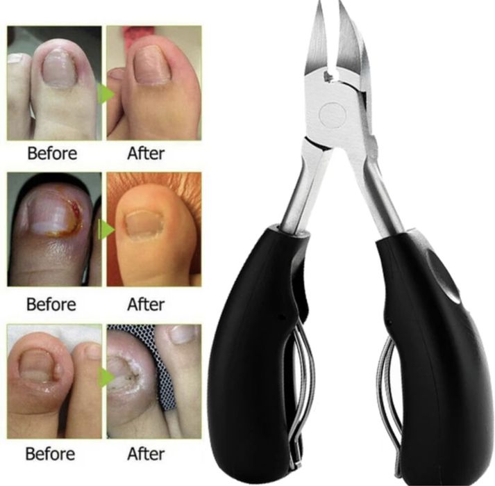 Клещи/Резачки за нокти и врастнали нокти