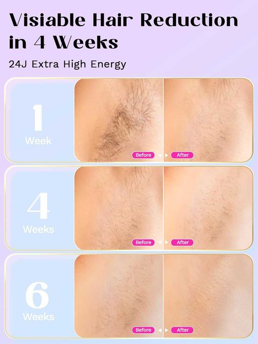 Устройство за лазерна епилация Wavytalk, с кабел (розово)