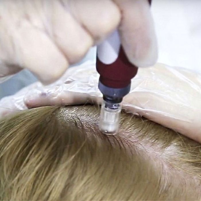 Фракционная мезотерапия