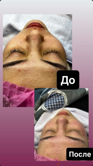 Чистка лица шымкент