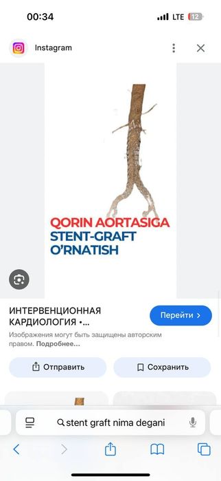 Srochna STENT-GRAFT 0.035  aorta tomirlariga yangi ochilmagan