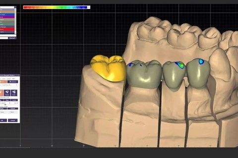 Exocad CAD/CAM | Zirkoniya va PMMA 3D modellar