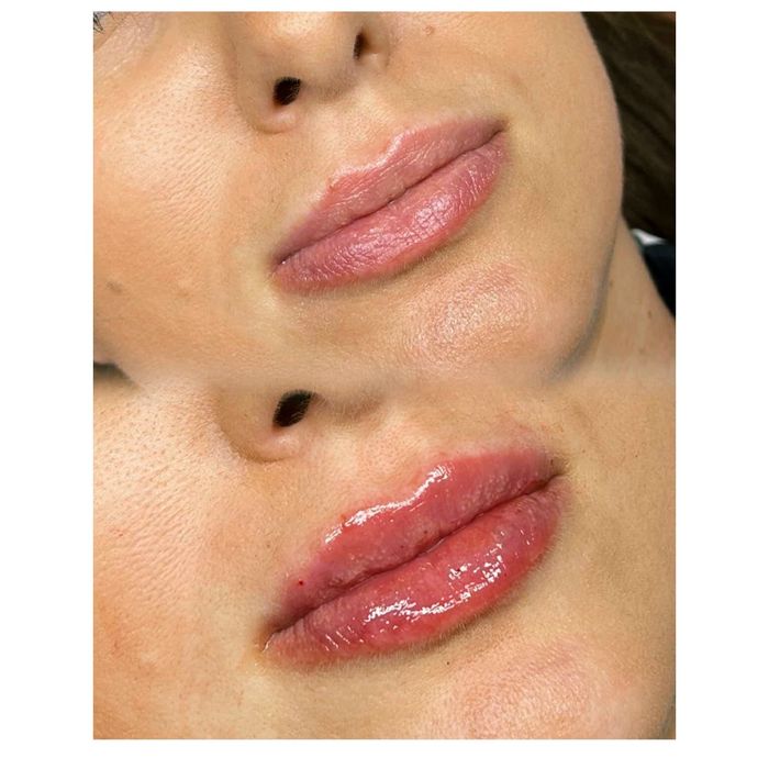 Volumizare buze -hyaluron pen