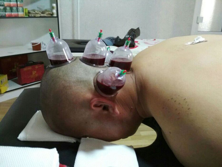 Седалищный нерв, гайморит лечение, хиджама