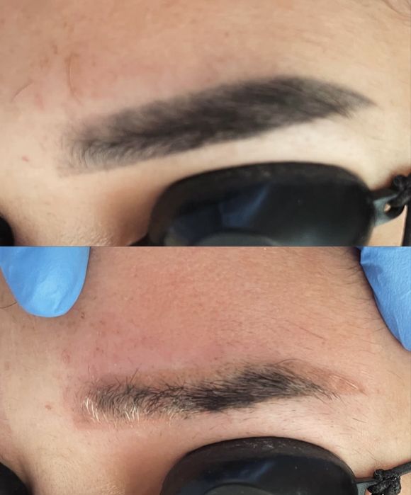 Удаление татуаж  татуировок за 2 процедуры безболезненно