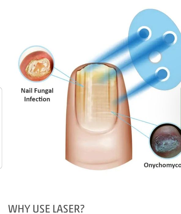 Лазерно лечение на гъбички по ноктите