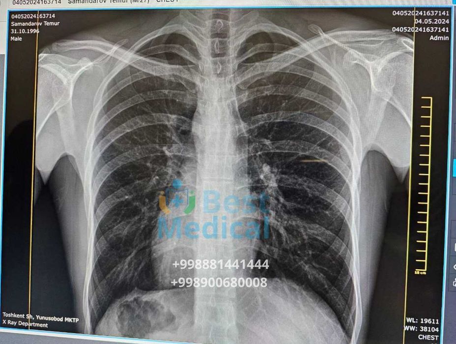 Portativ rentgen x-ray