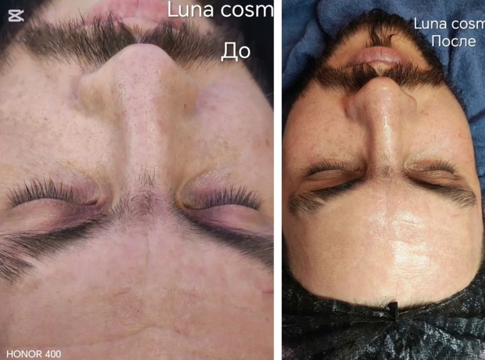 чистка лица , пилинг, лечение акне