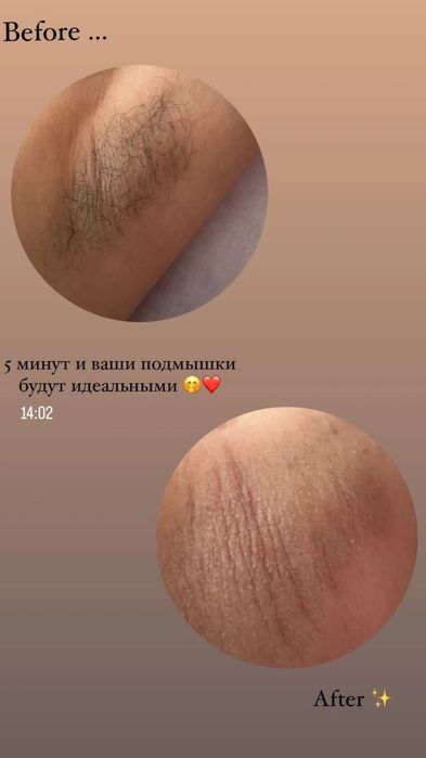 Шугаринг всего тела.