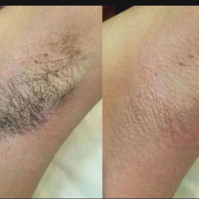 Депиляция мужская и женская