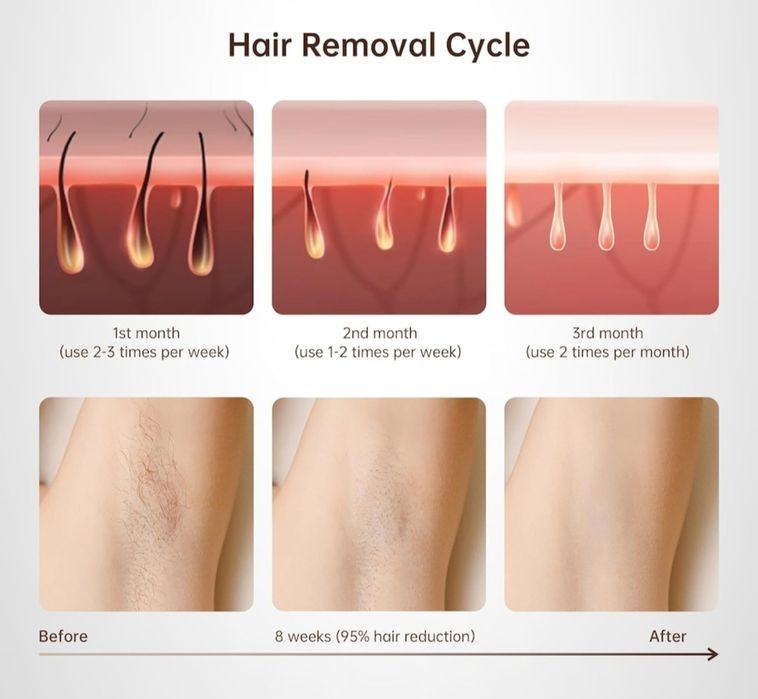 Epilator laser IPL, cu 999.900 de impulsuri luminoase, 3 moduri functionale HR/SC/RA, 9 intensitati, rapid, regenerare piele si indepartare acnee, alb