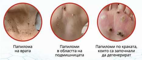 Писалка за брадавици и бенки Moles Remover