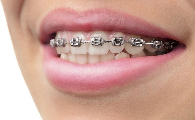 Болаларда тишларни брекет билан даволаш