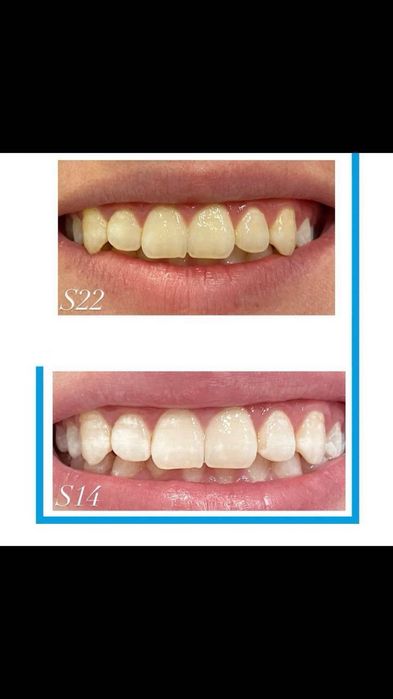 Бизнес с ДОХОДОМ ОТ МИЛЛИОНА в месяц отбеливание зубов