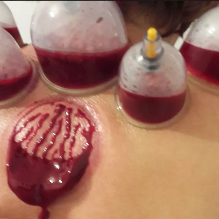 хиджама лечение по сунне.