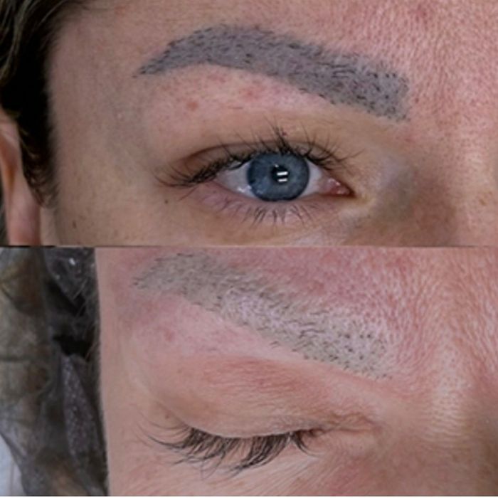 Nd YAG Удаление Татуажа и Татуировки! Мощный лазер!