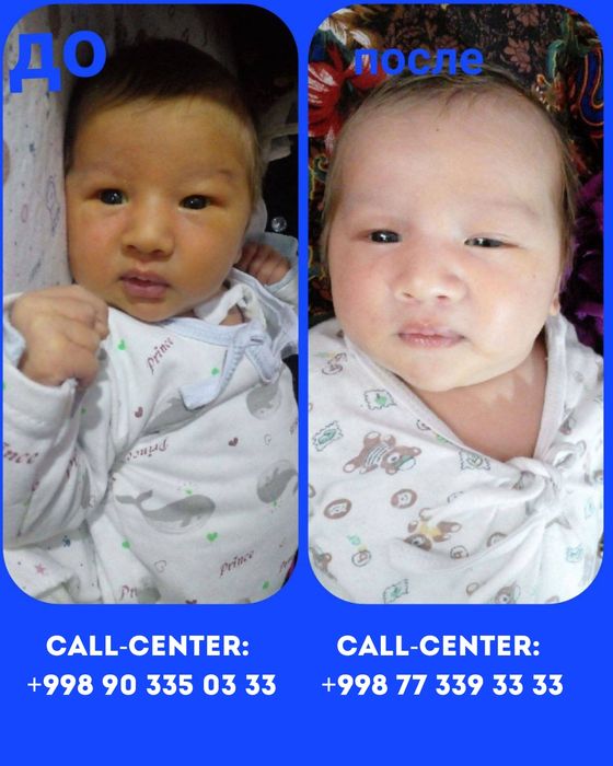 Фотолампа-лечим желтушку, результат с первых дней