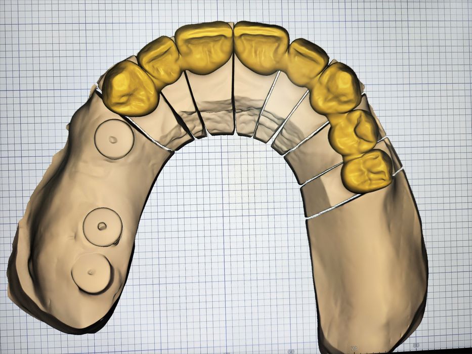 Дигитален Дизайн на Зъбопротезни конструкции от Зъботехник чрез Exocad