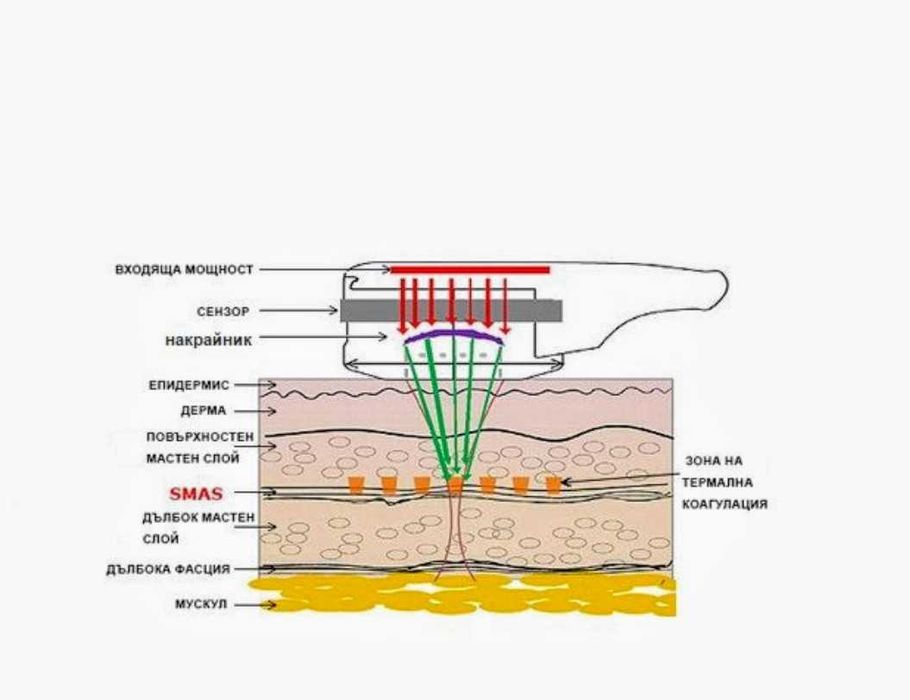 Hello Skin Хайфу апарат за дълбок фейс лифтинг и подмладяване