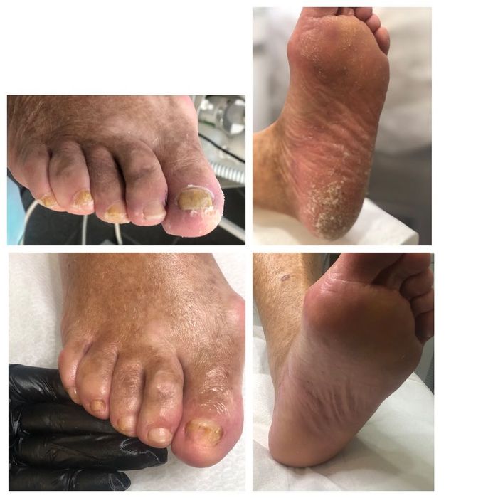 Pedichiura medicala.Instrumentar sterilizat in autoclav.Liftup gel