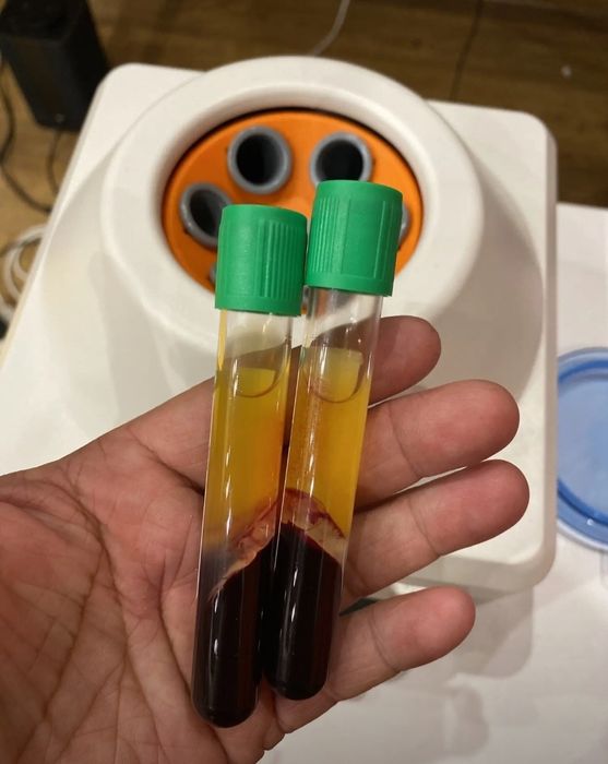 Центрифуга плазмалифтинг