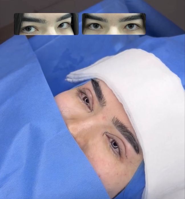 -50% CHEGIRMADA Qovoqlar Blefaroplastikasi