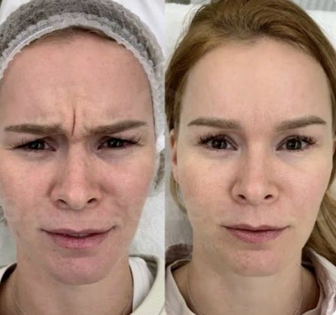 Ботокс,Траптокс,Гипергидроз.Botoks, Traptoks, Qùltiq terlash, gipergid