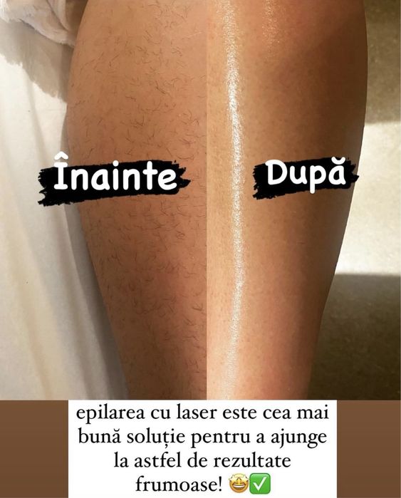 Epilare definitiva laser Bucuresti Sector 3 (zona trapezului)