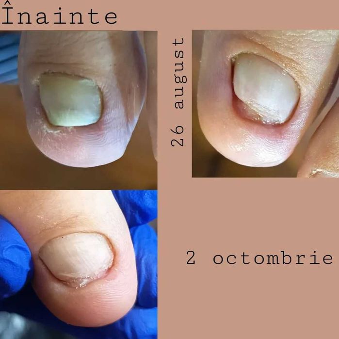 Pedichiură medicală Târgu Mureș