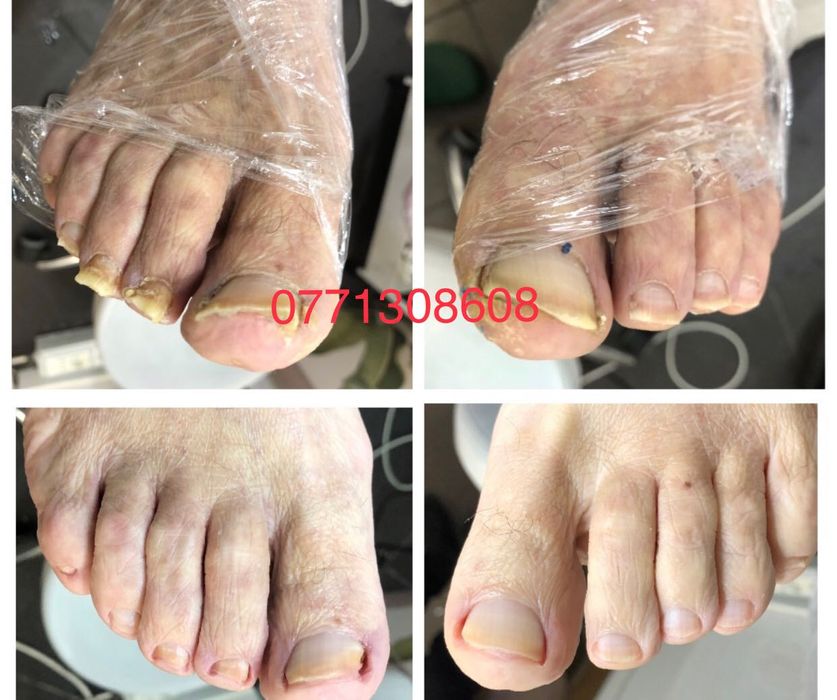 Pedichiura medicala.Instrumentar sterilizat in autoclav.Liftup gel