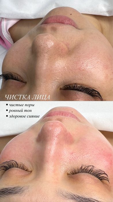 Плазмалифтинг, увеличение губ