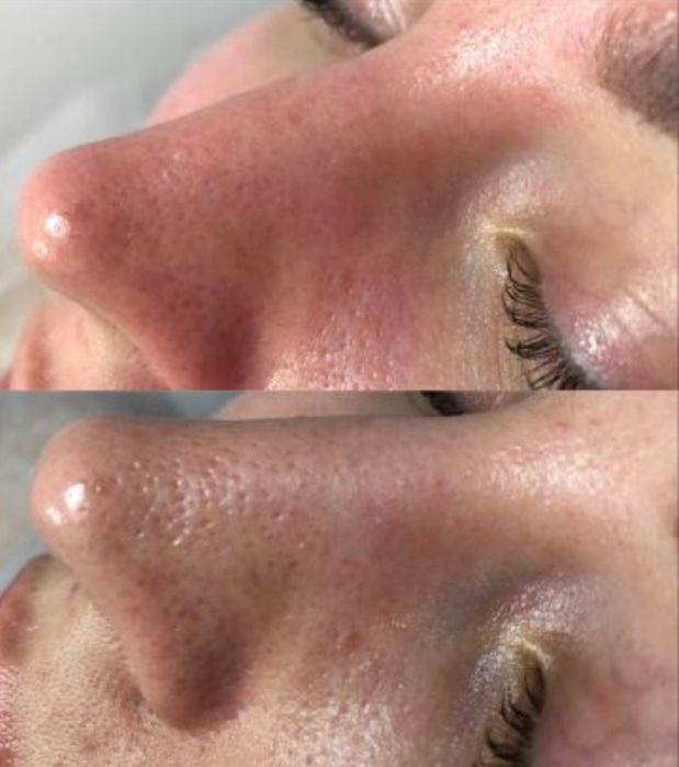 Чистка лица+пилинг по типу кожи.