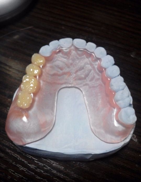 Съёмные зубные протезы