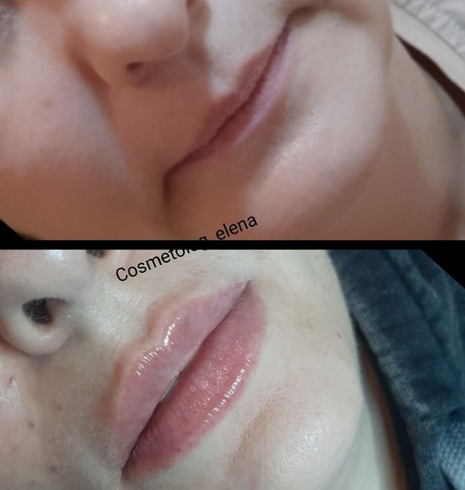 Увеличение губ. Филлер юж. Корея. СКИДКИ