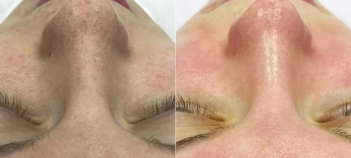 Карбоновый пилинг,7000  омоложение