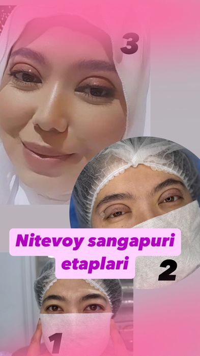 Блефаропластика Броулифтинг