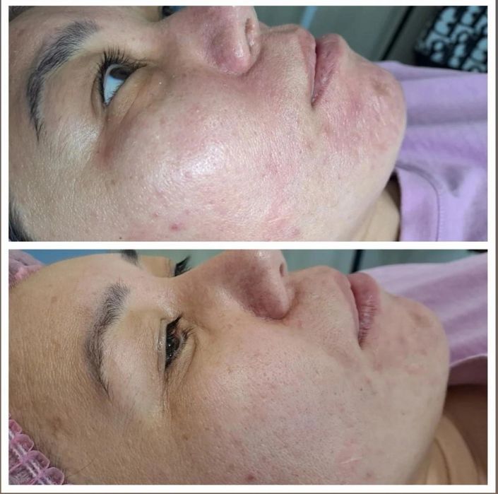 Чистка лица 7000т.