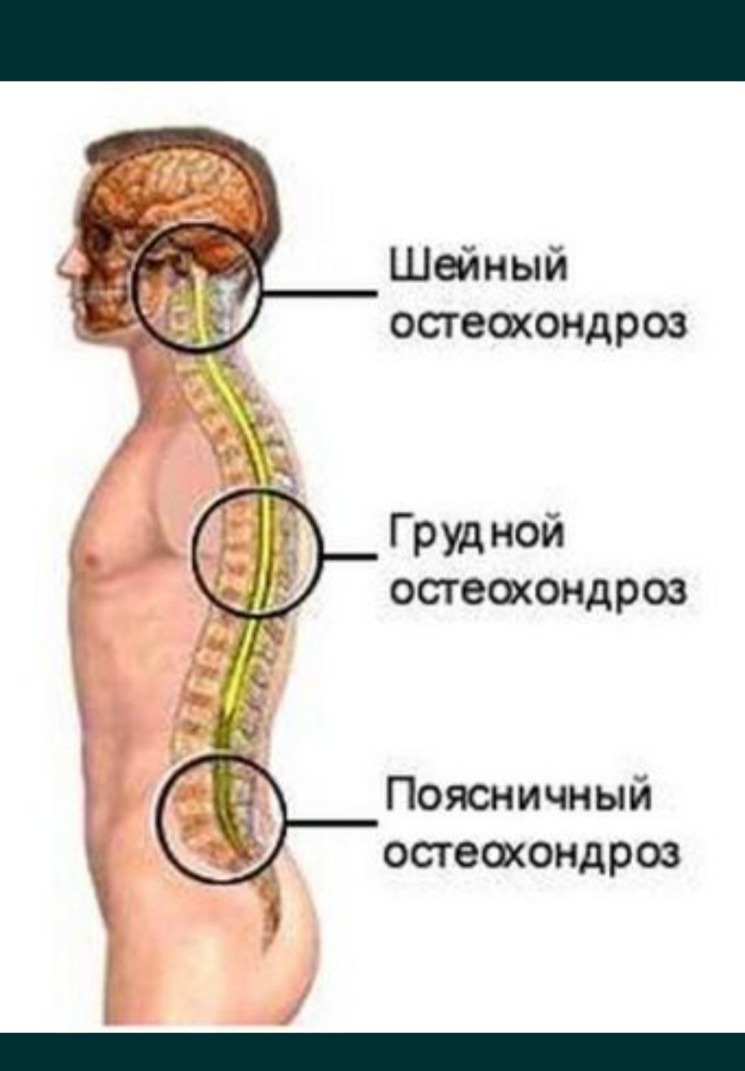 Грудной отдел позвоночника симптомы и лечение. Шейно-грудной остеохондроз симптомы. Остеохондроз th5-th8. Остеохондроз грудного отдела симптомы. Остеохондроз шейный грудной поясничный.