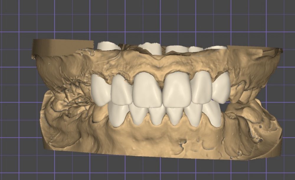 Импланты от 49.999.