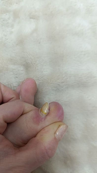 Лечение и исправление вросших ногтей.  Падолог