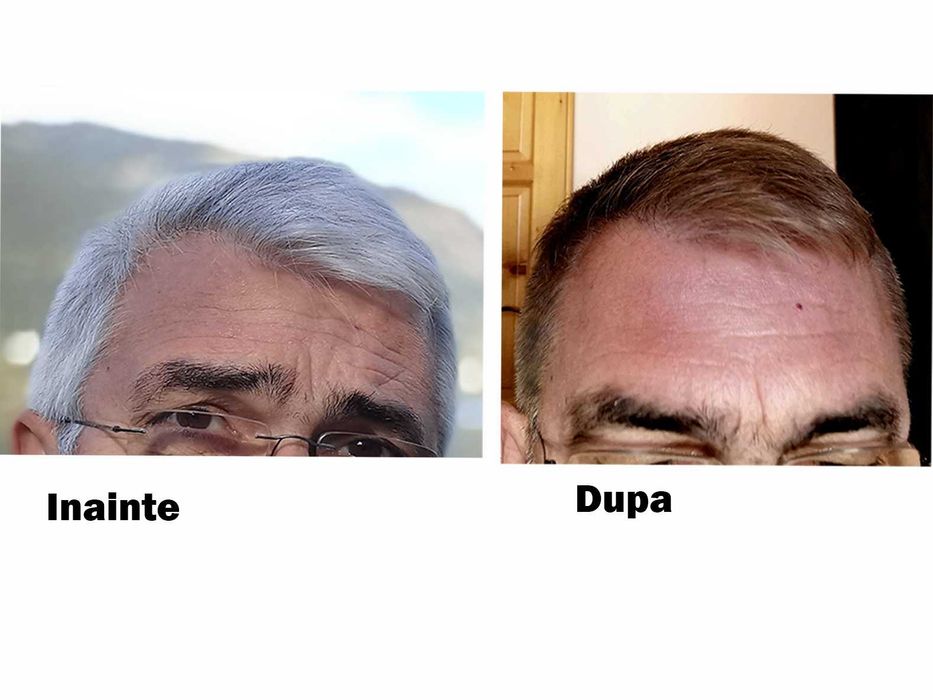 Lotiune anti caruntire