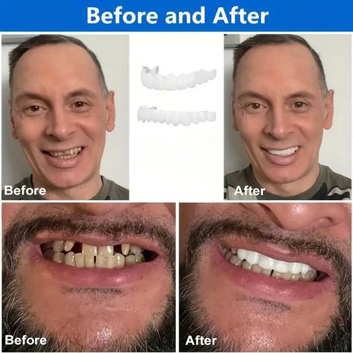 Dinti falsi Proteze dentare 2 seturi dinți superiori inferiori unisex