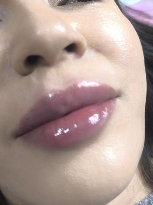 Красота это -губки бантиком на новый год! Botox full face