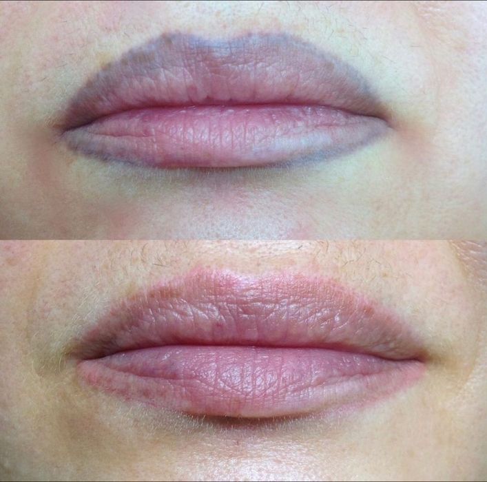 Обучение  лазером  татуаж и тату