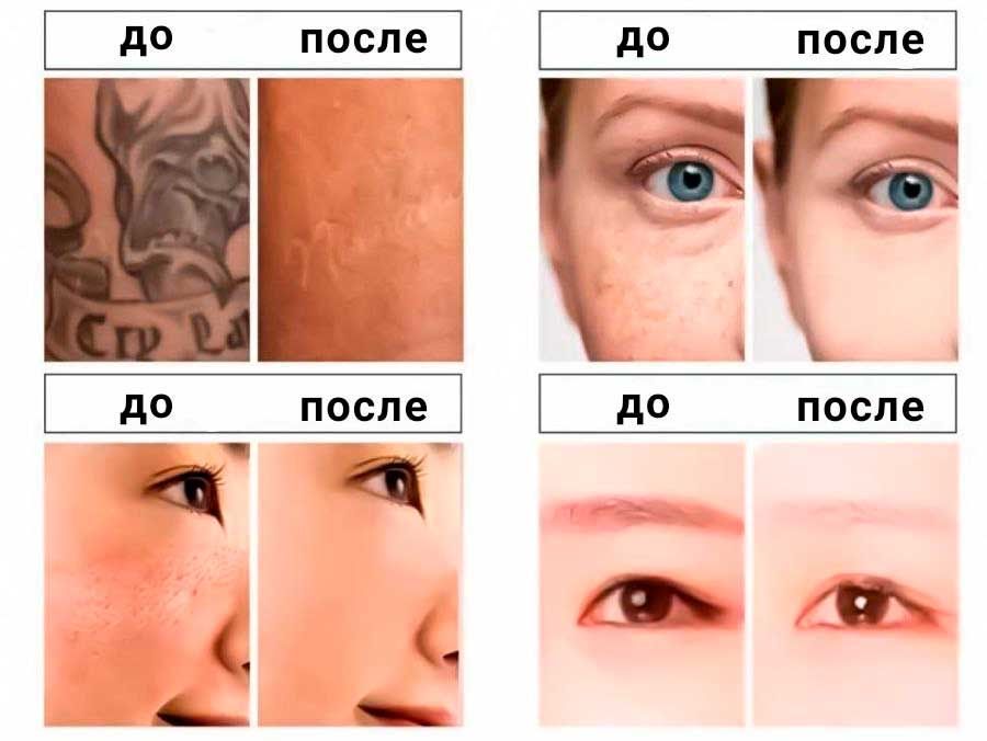 Лазерный аппарат Q-switch для удаления татуировок