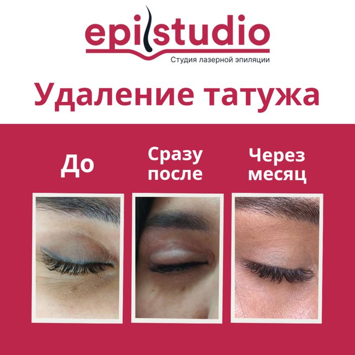 Удаление татуажа и татуировок