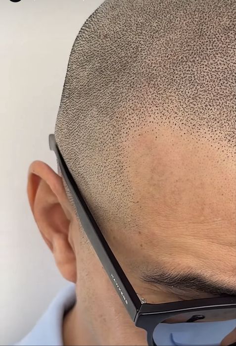 Curs SMP micropigmentare scalp fizic sau online