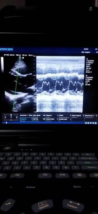 УЗИ аппарат портатив