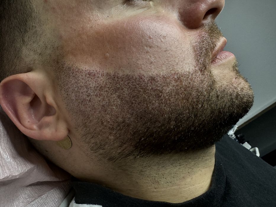 Curs de Micropigmentare Scalp și Barba - Dermopigmentare SMP Academie