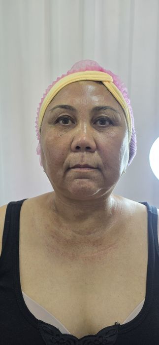 МиМикроигольчатый РФ лифтинг